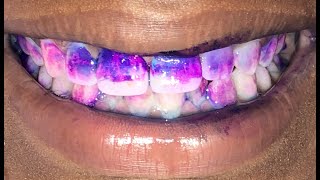 How to Identify Plaque Accumulation on Teeth [upl. by Htelimay]