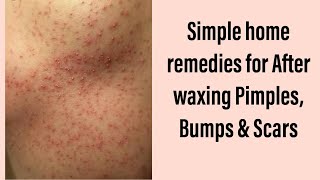 DIY for After wax Pimples and bumps [upl. by Keg]