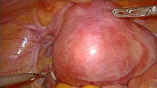 Large fibroid uterus TLH unedited [upl. by Philomena]