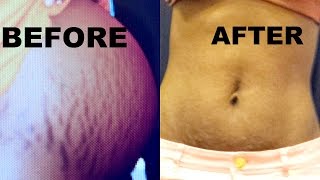 HOW TO GET RID OF STRETCH MARKS [upl. by Mac]