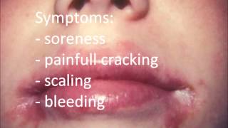 Angular Cheilitis Treatment permanent  How to Cure Angular Cheilitis in 12 hours [upl. by Lenes]