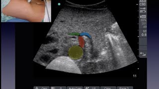 Aorta Ultrasound [upl. by Hershell]