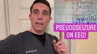 I Recorded a Pseudoseizure on EEG [upl. by Eenttirb]