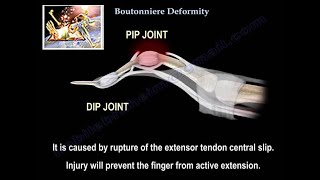 Boutonniere Deformity  Everything You Need To Know  Dr Nabil Ebraheim [upl. by Anrak]