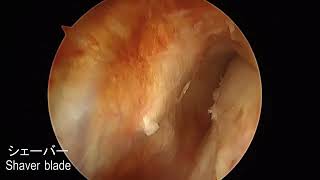 Equine Carpal Sheath Tenoscopy  Radial Osteochondroma [upl. by Nnawtna140]