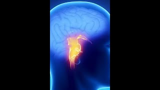 Brainstem syndromes stroke localization part 3 [upl. by Herman]