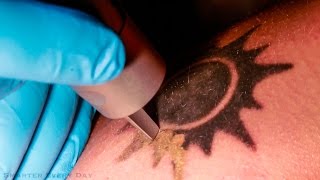 How Laser Tattoo Removal Works  Smarter Every Day 123 [upl. by Tait]