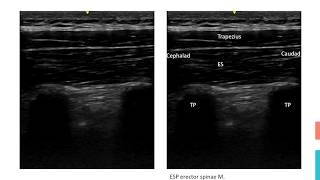 Erector spinae block [upl. by Wilsey]