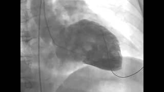 Ventricular Fibrillation during Left Ventriculography [upl. by Burkitt]