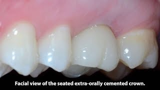 Immediate Placement and Restoration of a Maxillary First Molar with an ExtraOrally Cemented Crown [upl. by Bathesda]