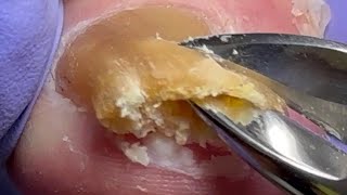 Trim onychomycosis super thick nails very large nails【Doctor Liu Pedicure】 [upl. by Merilee]