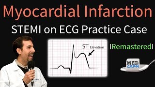 Myocardial Infarction  STEMI on ECG  Practice EKG [upl. by Rois]