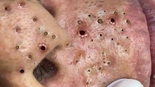 Big Cystic Acne Blackheads Extraction Blackheads amp Milia Whiteheads Removal Pimple Popping  1099 [upl. by Aronoff408]