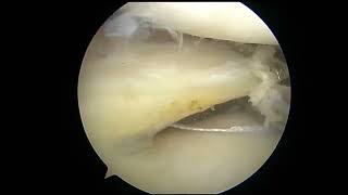 Circumferential Cross Stitch Suture for Longitudinal Lateral Meniscal Tear Around the Popliteal Tend [upl. by Anirres981]