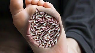 ASMR Bugs Kadu Infected On Foot  ASMR While Walk Before Takes Care  ASMR Surgery Treatment [upl. by Doi620]