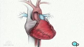 Balloon Angioplasty Coronary Angioplasty Surgery [upl. by Howlan]