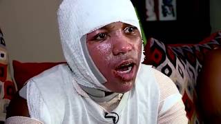 15yearold severely burned in hot water viral challenge [upl. by Roer553]