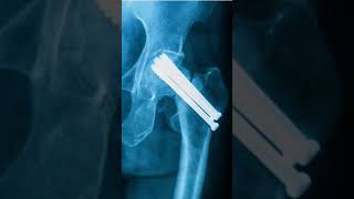 hip joint fracture treatment with surgical screwlikeshareandsubscribedoctoranatomy [upl. by Valda]