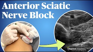 UltrasoundGuided Anterior Sciatic Nerve Block [upl. by Eresed492]