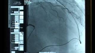 Case 02 Antegrade and Retrograde approach Bilateral Sheathless Radial access [upl. by Rentschler706]