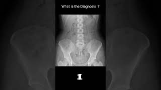 Normal  with faeces Abdominal Xray  Abnormalities  Normal reference 61 radiologychannel007 [upl. by Inattyrb438]