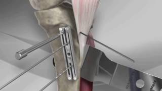 Tibial Tubercle Osteotomy with Arthrex® T3 AMZ System [upl. by Urban]