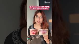 How to cure canker sore or chaale  Nutshell shorts 158  shorts [upl. by Siul]