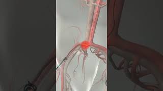 Learn How Cardiac Catheterization Works [upl. by Esadnac]