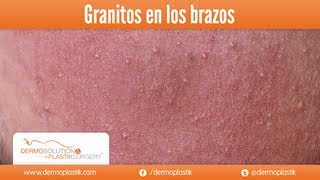 Dermoplastik  Granitos en los brazos [upl. by Namzzaj612]