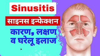 Sinusitis in hindi  साइनस के कारण लक्षण व इलाज  sinus infection  common ENT disease [upl. by Brie]