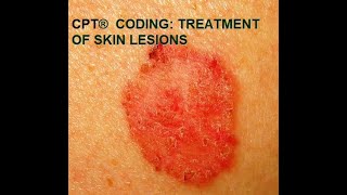 CPT® coding for Skin Lesions [upl. by Stearns]