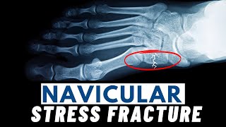 Navicular Stress Fractures  Symptoms Causes Diagnosis amp Treatment [upl. by Ailey]