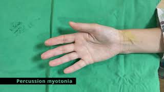 Percussion myotonia from the patient with myotonic dystrophy [upl. by Iorgo]