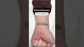 Before amp After Tattoo Removal at Removery😍 [upl. by Ellenet]