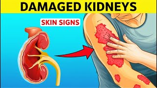 9 Skin Signs That May Indicate Your Kidneys Are Damaged [upl. by Vinni]