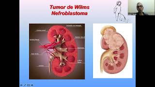 AULA DE TUMOR DE WILMS OU NEFROBLASTOMA [upl. by Havstad509]