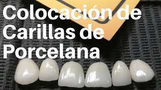 COLOCACIÓN de CARILLAS de Porcelana👅carillasdentales [upl. by Cheyney943]