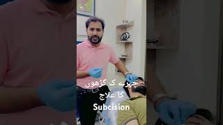 Subcision for acne scars dermatology fullbodywhiteningtreatment doctor hospital medicaltherapy [upl. by Ahsehyt369]