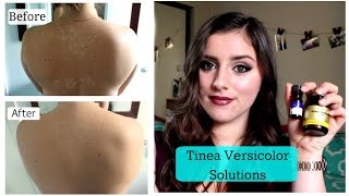 Tinea Versicolor SOLUTIONS TNBeauty94 [upl. by Ashman286]