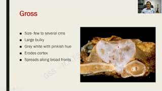 Osteochondroma Chondrosarcoma and Aneurysmal Bone cyst  Bone and Joints RATS in Pathology [upl. by Aciemaj289]