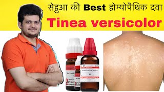 सेहुआ की Best Homeopathic Medicine  Tinea versicolor Remove Combination  How to Use [upl. by Aitsirt977]