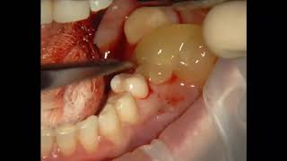 Treatment of alveolitis with ClotPRF Treatment of alveolitis with ClotPRF aprf [upl. by Fe]