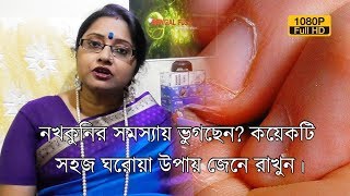 নখকুনির সমস্যায় ভুগছেন কয়েকটি সহজ ঘরোয়া উপায় জেনে রাখুন।  EP 253 [upl. by Benedicto]