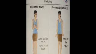 ICP  Posturing  Decorticate Flexesor  Decerebrate Extender posturing brain headinjury [upl. by Aivin904]