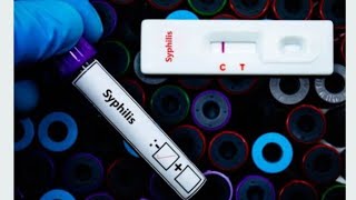 How To Use Syphilis Rapid Diagnostic Test  VDRL Test [upl. by Sanoy]