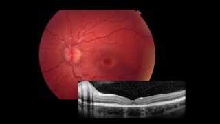 Retina Imaging amp ERG [upl. by Anissa]