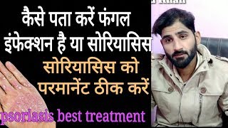 कैसे पता करें फंगल इंफेक्शन है या सोरियासिस।psoriasis best herbal treatment [upl. by Boatwright]