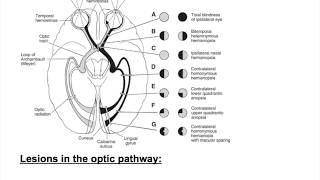 Optic nerve lesions Bitemporal hemianopia heteronymous hemianopiaHomonymous hemianopia [upl. by Adelle172]