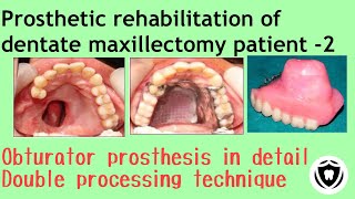 Prosthetic rehabilitation of dentate maxillectomy patient  Part 2 [upl. by Adidnere472]