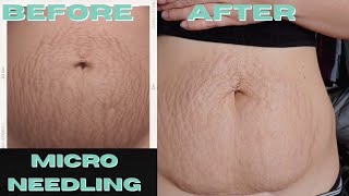 I Got Professional Microneedling Done on my Stretch Marks Results and What to Expect [upl. by Nednil]